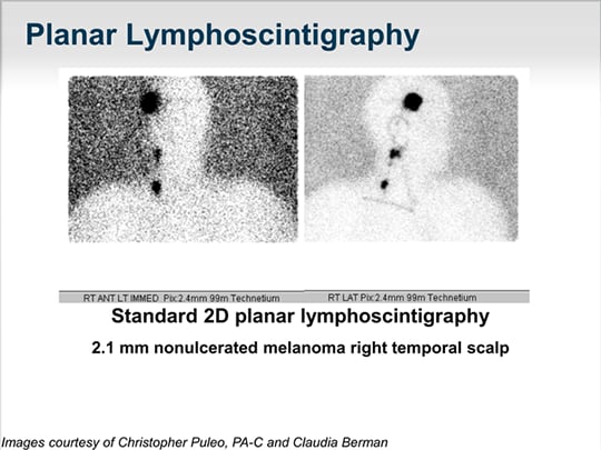 Latest Developments On Optimal Lymph Node Mapping For Patients With 3809