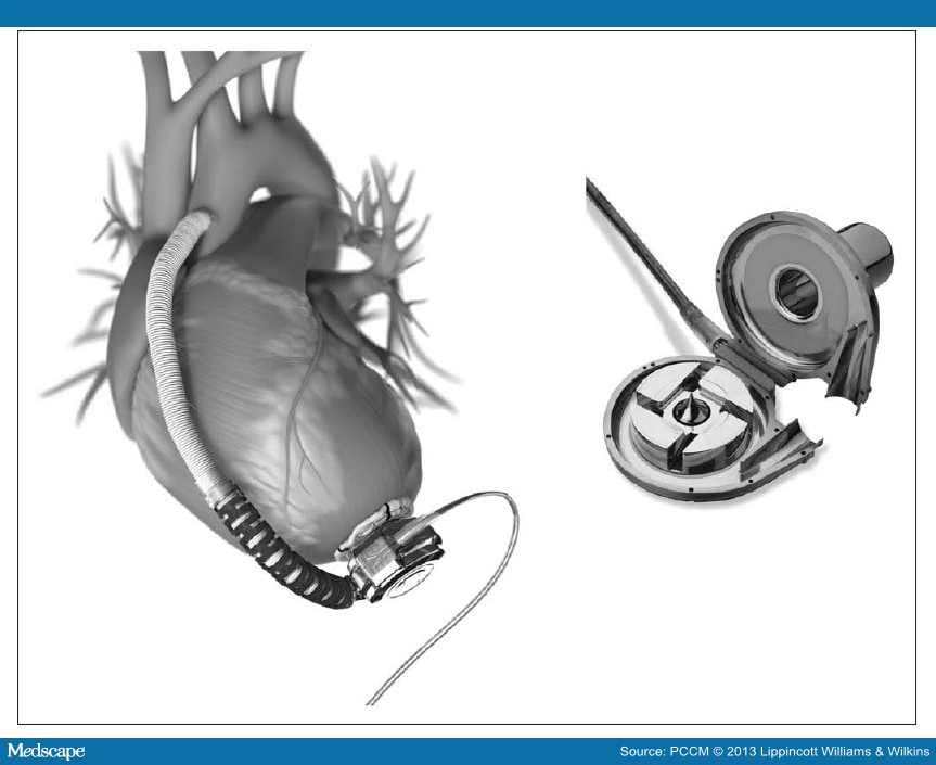 Pediatric Ventricular Assist Devices - Page 3