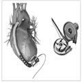 Pediatric Ventricular Assist Devices - Page 3
