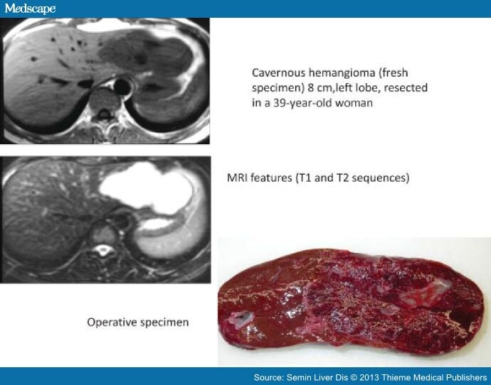 Diagnosis And Management Of Benign Liver Tumors - Page 2