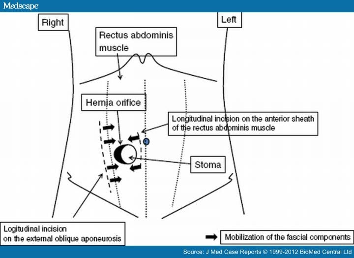 A Novel Method of Parastomal Hernia Repair