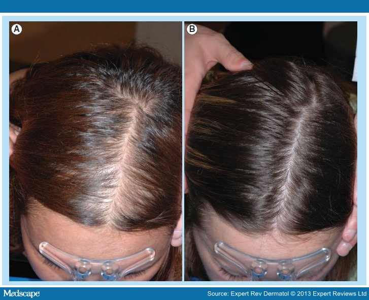 how effective is minoxidil for hair loss