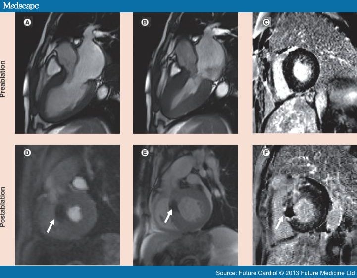 Advances of Cardiovascular MRI in Hypertrophic Cardiomyopathy