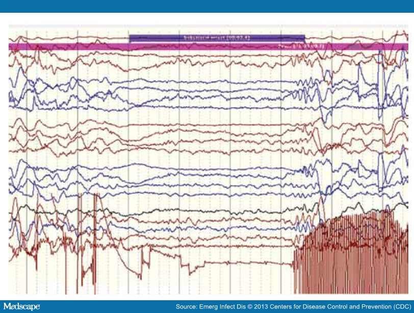 Nodding Syndrome