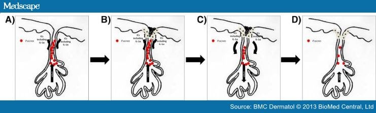 Toll-like Receptor 2 Activation And Comedogenesis In Acne - Page 6