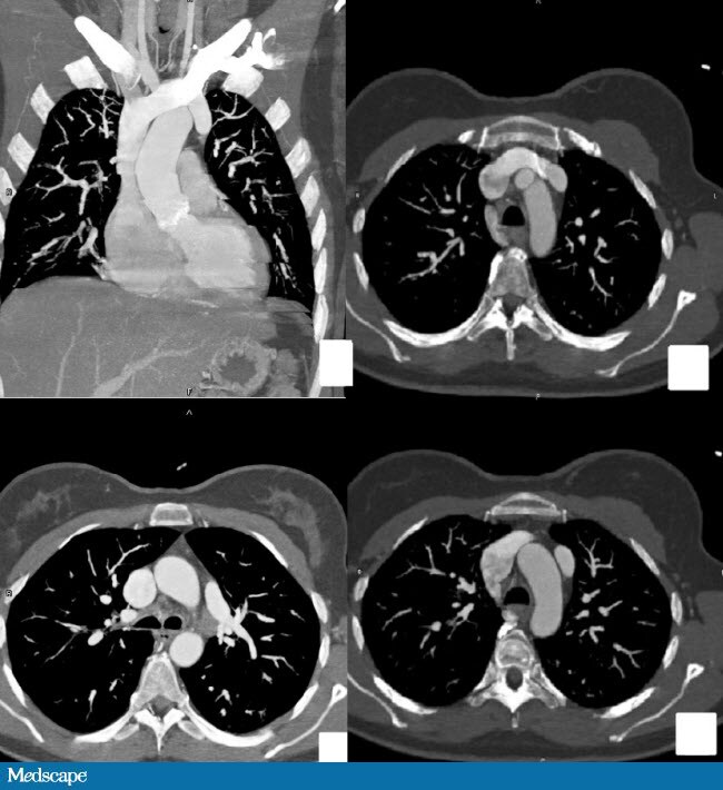 What is the correct diagnosis of the following image?