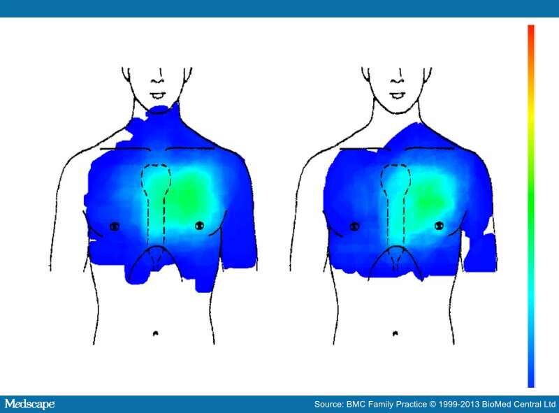 Chest Pain: Is the Location of Pain Diagnostically Helpful? - Page 4