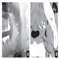 Tonsilloliths on CT and Panoramic Radiographs - Page 4