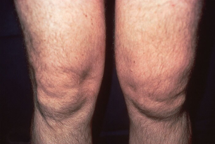 home remedies for arthritis swelling in knees