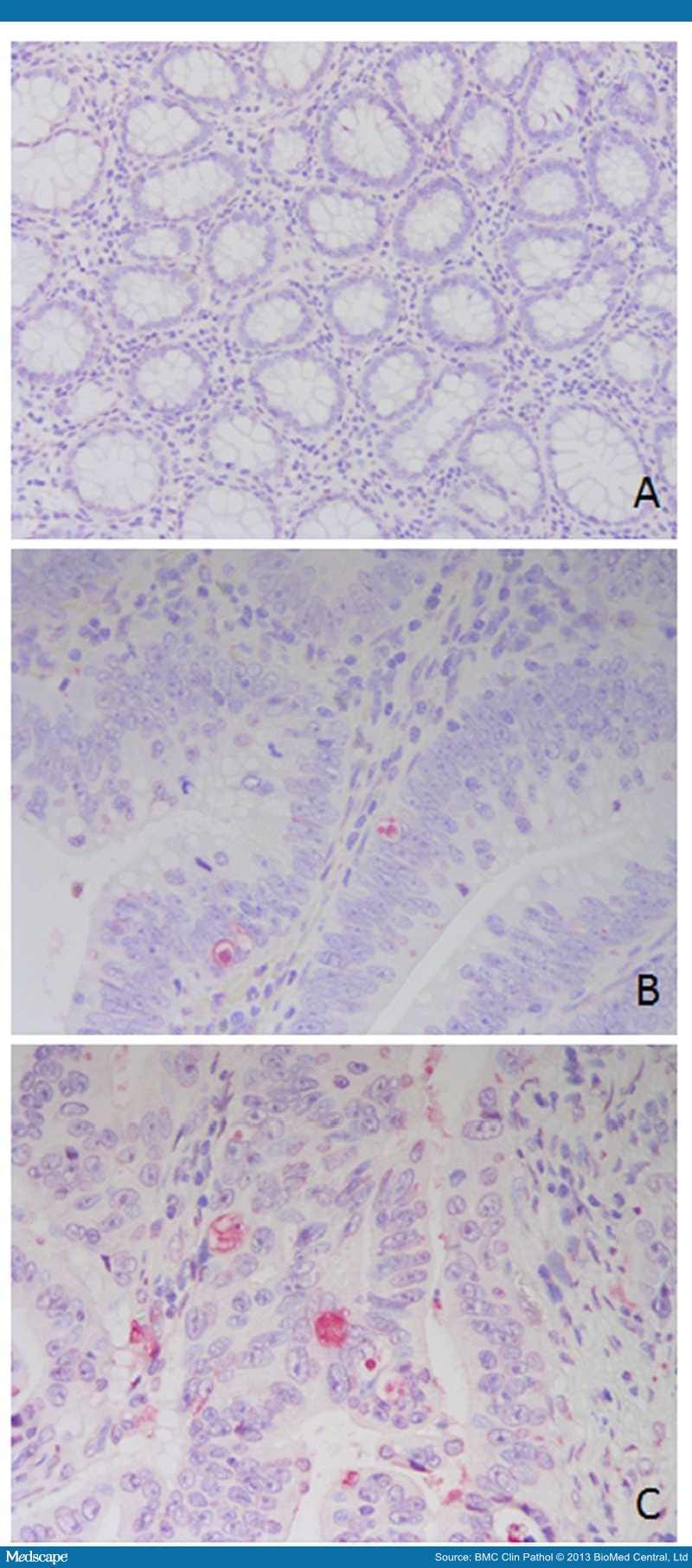 Role and Prognostic Value of Apoptosis in Colorectal Cancer - Page 4