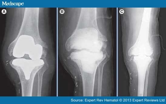 Special Features of Total Knee Replacement in Hemophilia - Page 10