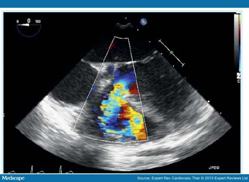 Role of Imaging in Interventions on Structural Heart Disease - Page 5