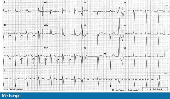 P Waves? U Waves? Or Both? - Page 2