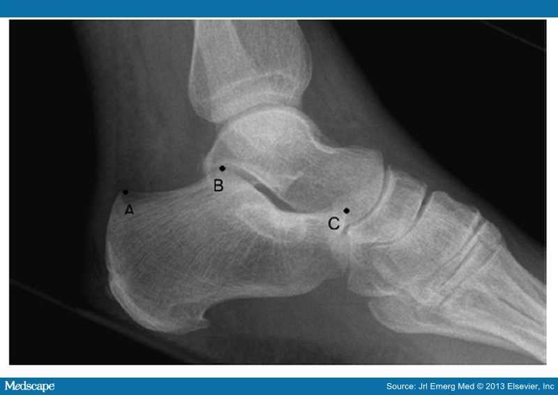 Diagnostic Accuracy of Bohler's Angle in Calcaneus Fractures