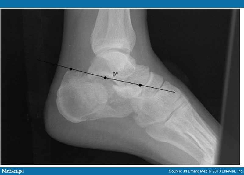 Diagnostic Accuracy of Bohler's Angle in Calcaneus Fractures