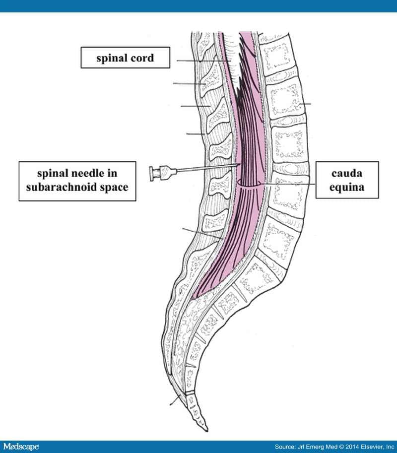 Pediatric Lumbar Puncture and Cerebrospinal Fluid Analysis