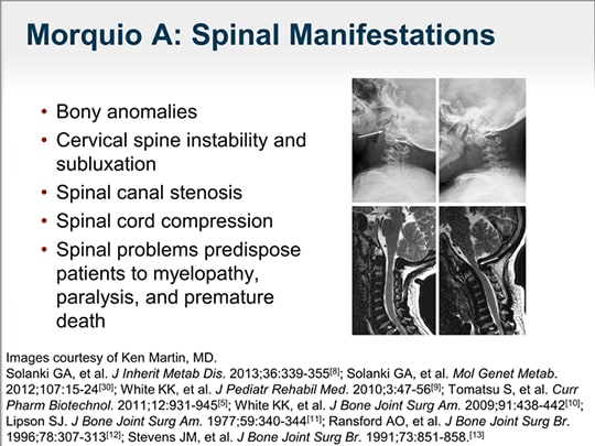 Diagnosis and Treatment of Morquio A Syndrome: Expert Perspectives