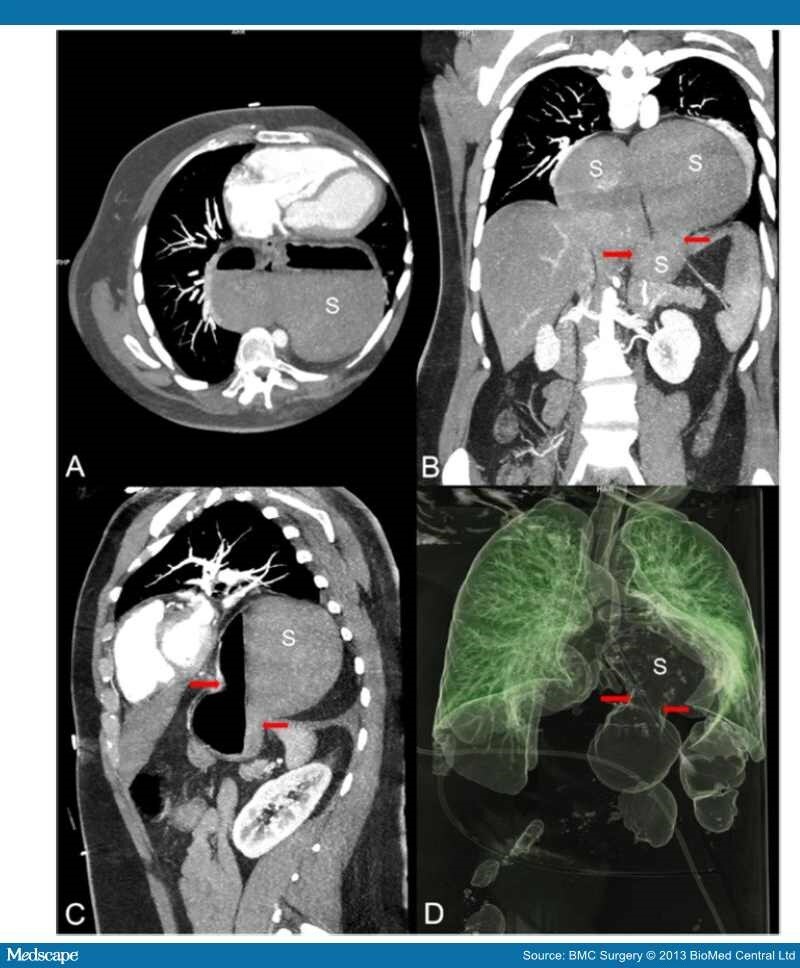 Management of Acute Upside-down Stomach - Page 3