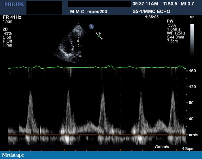 Patient in the Coronary Care Unit... What's Next?