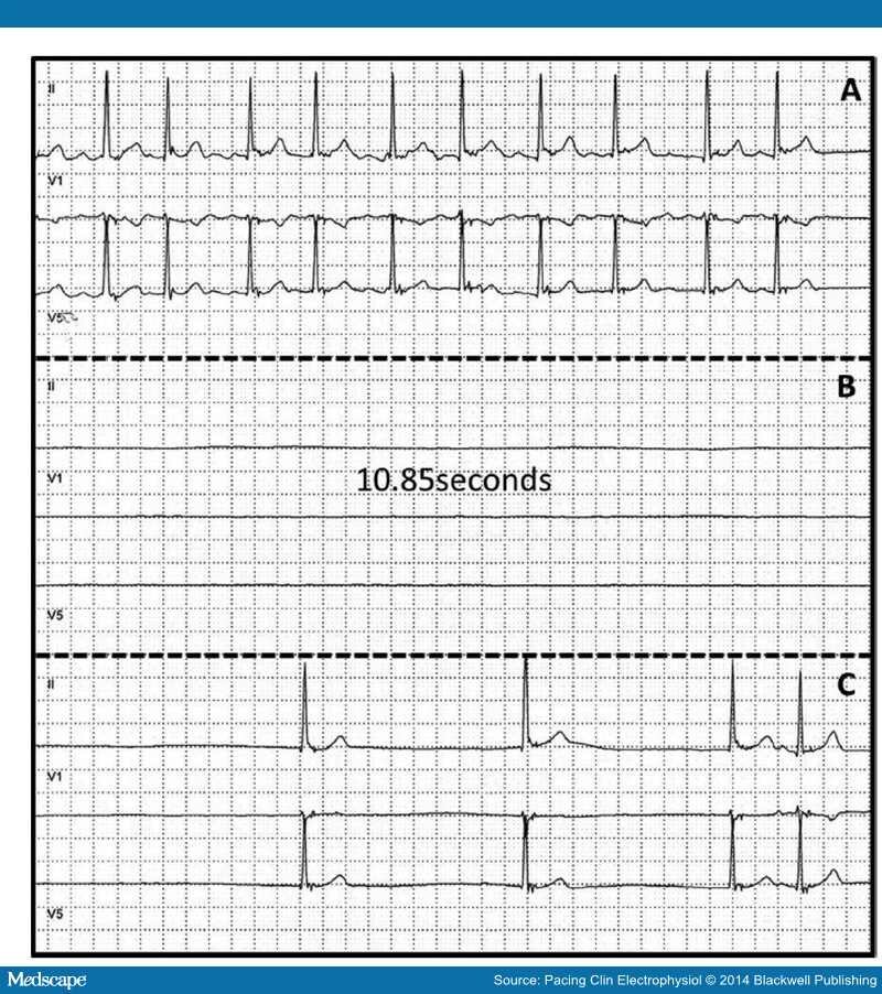 Pacing or Ablation Which Is Better for TachyBrady Syndrome? Page 7
