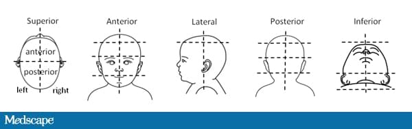 Nonsynostotic Deformational Plagiocephaly