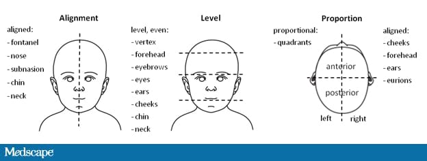 Nonsynostotic Deformational Plagiocephaly - Page 5