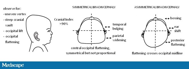 Nonsynostotic Deformational Plagiocephaly