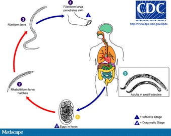 tumor choroid plexus papilloma adalah