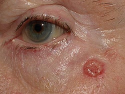 Fast Five Quiz: Basal Cell Carcinoma - Page 2