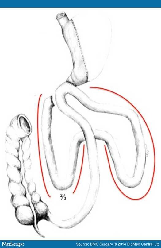 Loop Duodeno-Enterostomy With Sleeve Gastrectomy - Page 3