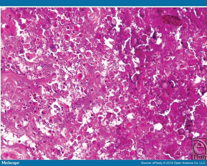 Idiopathic Tumoral Calcinosis in Hand