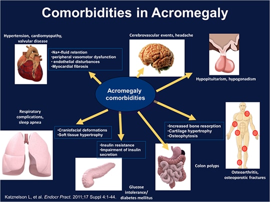 Acromegaly: Diagnosis And Management Options (Transcript)