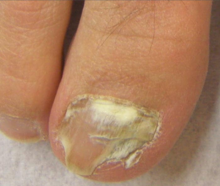 Effective Treatment of Onychomycosis