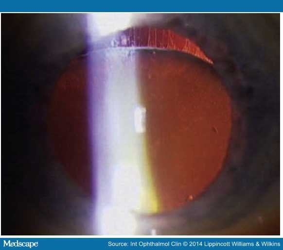 Surgical Approach to the Pseudoexfoliative Cataract
