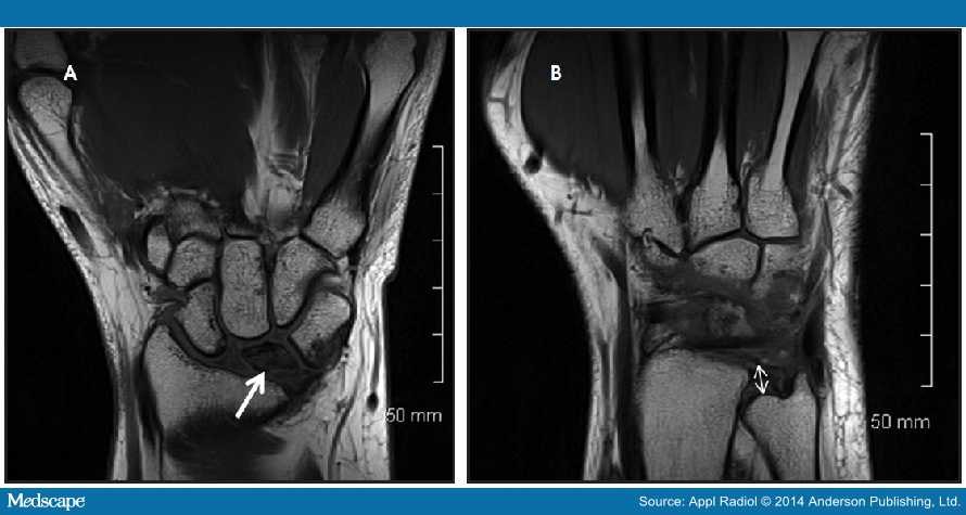 MRI of the Wrist