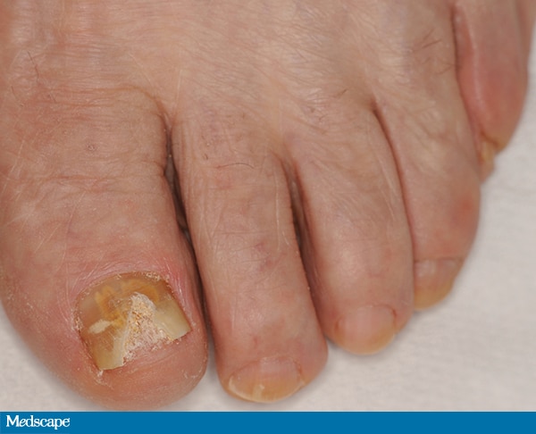 Onychomycosis: Common, Challenging, and More Than Cosmetic