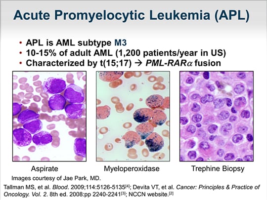 Issues and Challenges in Treating Acute Promyelocytic Leukemia (Transcript)