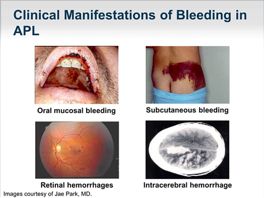 Issues and Challenges in Treating Acute Promyelocytic Leukemia (Transcript)