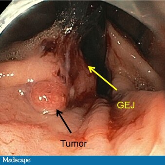 A New Operative Approach For Gej Adenocarcinoma