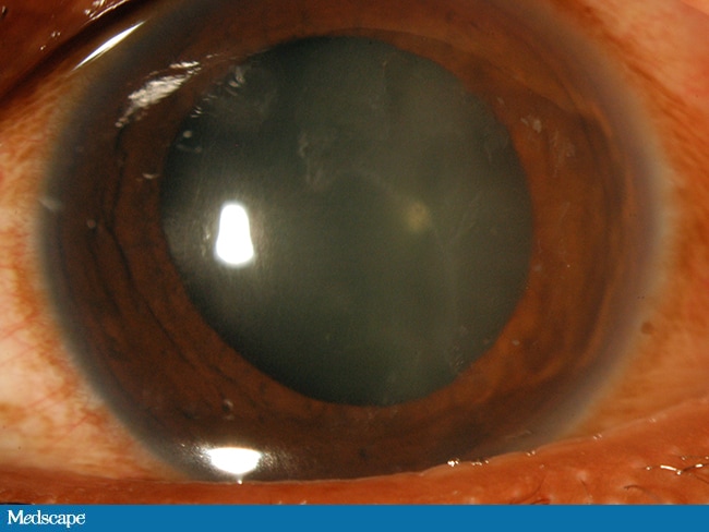 Corneal Abrasions: Managing A Commonly Occurring Injury - Page 3