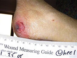 Fast Five Quiz: Diabetic Foot Ulcer