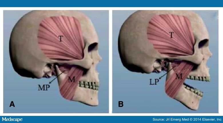 The Syringe Technique For Tmj Dislocations Sinaiem - vrogue.co