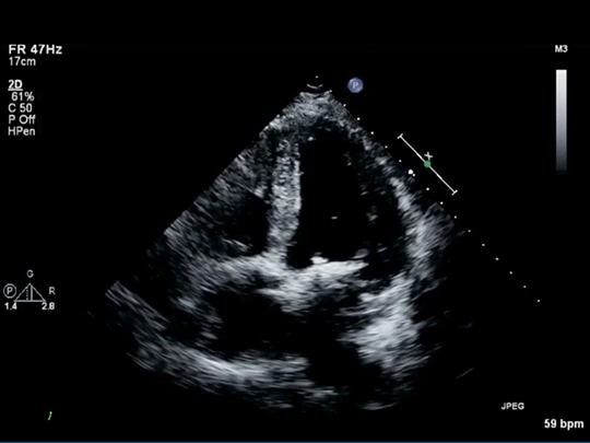 Where Did the Mitral Regurgitation Go?