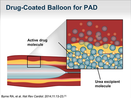 Improved Patency For Peripheral Artery Disease: Drug-Coated Balloons ...