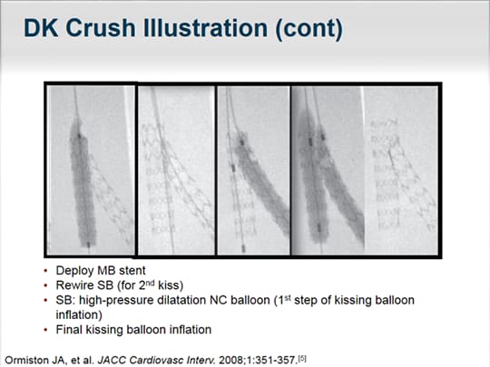 A Virtual Journey of Complex Stenting