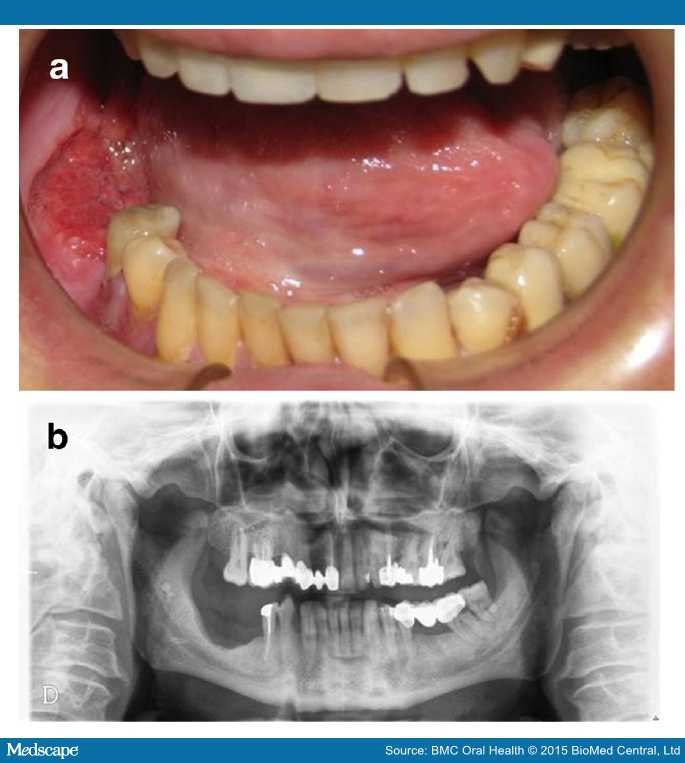 Dental Implant PostSurgery and Radiotherapy for Oral Cancer Page 3