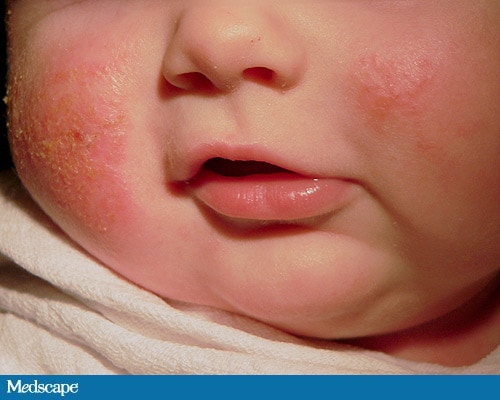 Twin Infants With Rashes: Same Diagnosis? - Page 2