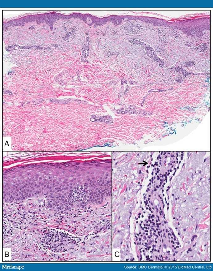 Photoallergic Reaction in a Patient Receiving Vandetanib - Page 3