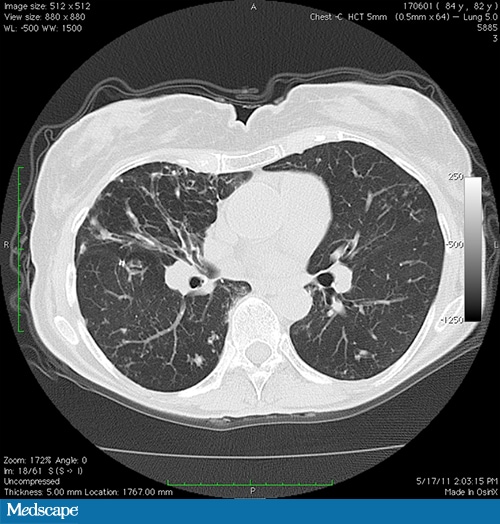 State of the Art: Treating Nontuberculous Mycobacterial Infections