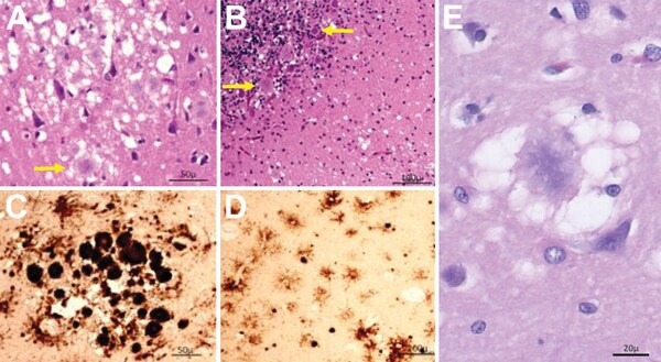 recent-us-case-of-variant-creutzfeldt-jakob-disease-global-implications